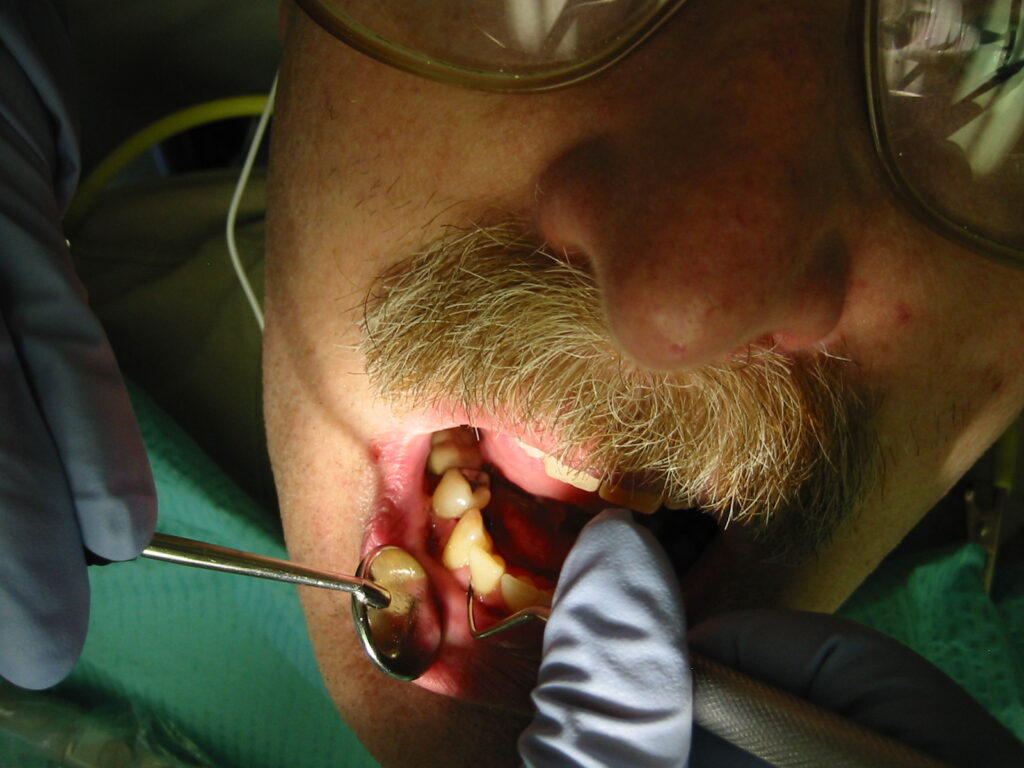 Tooth scaling Description: Dental hygienist scaling a patient's teeth during a periodic tooth cleaning. Viewpoint location: Seattle, Washington Date a