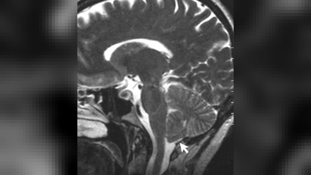A T2-weighted sagittal MRI scan, from a patient with Chiari-like symptomatology, demonstrating tonsillar herniation less than 3 mm