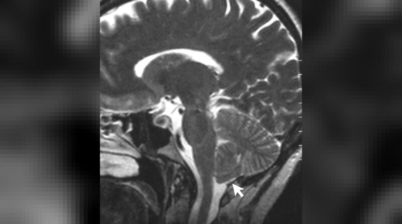 A T2-weighted sagittal MRI scan, from a patient with Chiari-like symptomatology, demonstrating tonsillar herniation less than 3 mm